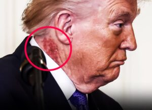 Scabbing neck rash fuels new health speculation around Donald Trump