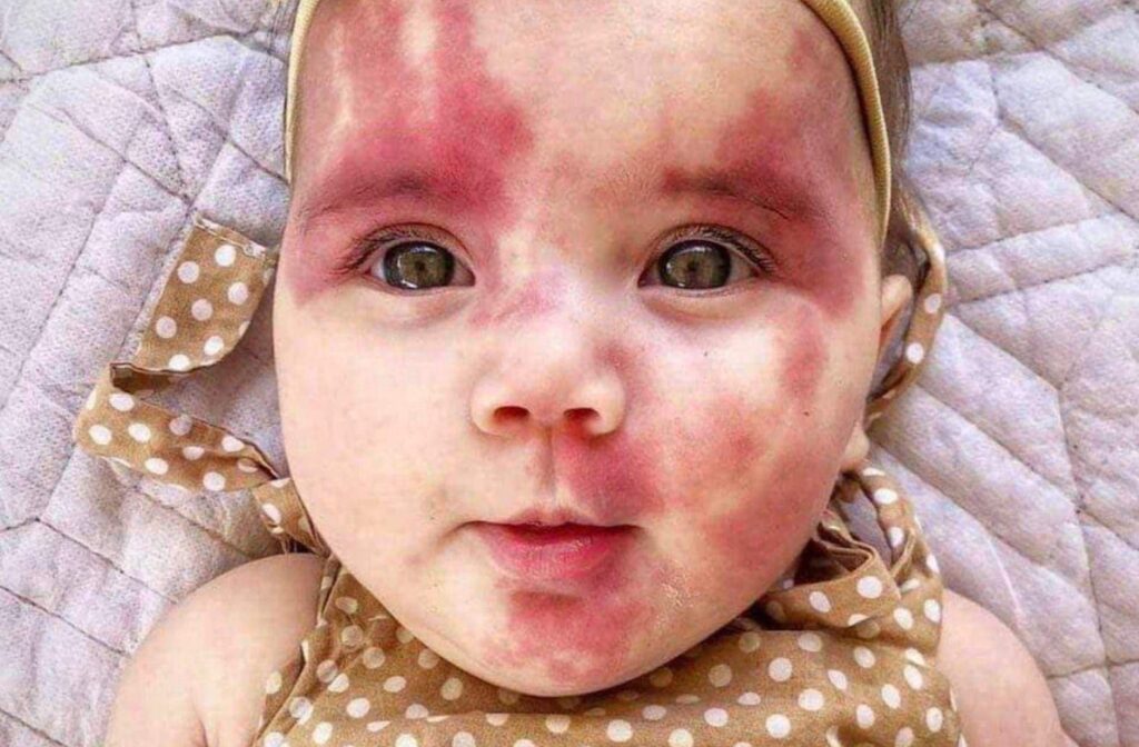 Baby With Red Birthmark Called ‘Hideous’ And ‘Defective’, But Wait Till You See This Beautiful Kid Now