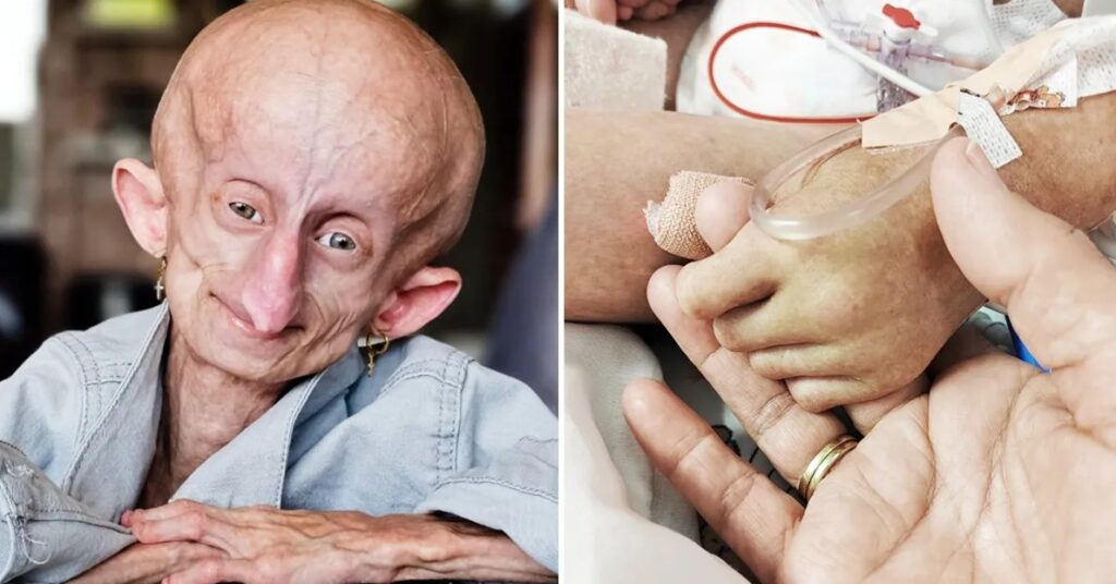 Beandri Booysen: Girl in South Africa with progeria dies
