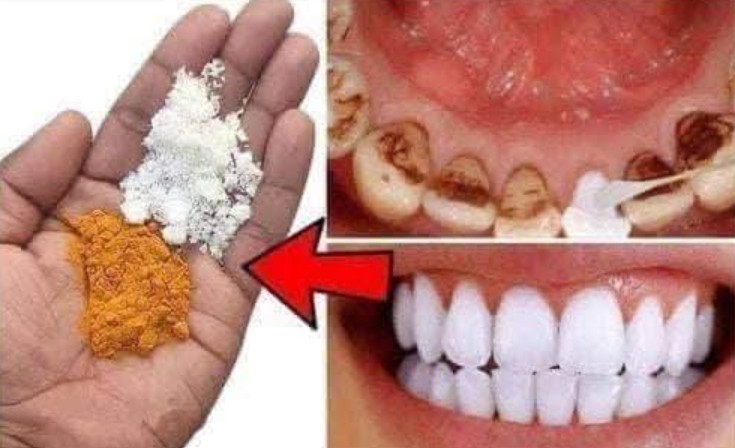 Natural Teeth Whitening – Say Goodbye to Yellowing and Tartar