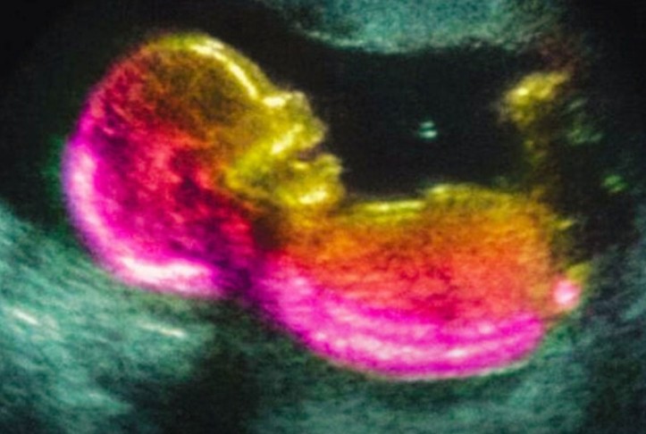 Scientists May Have Actually Found One Of The Causes Of Autism