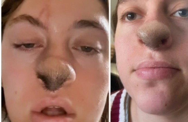 Dog Bite Leads To Hair Growing On Woman’s Nose: Photo Reveals Shocking Aftermath!