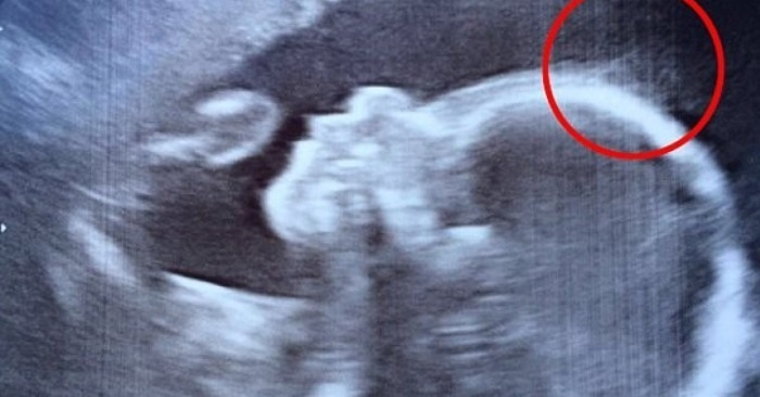Doctors spotted something unusual on the ultrasound — now this baby turns heads everywhere she goes