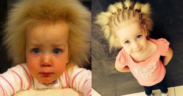 «The baby with the uncombable hair syndrome years later»: This is how the child with unusual hair has changed