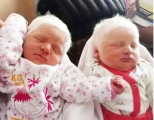 The First Ever Albino Twins Born In Argentina Will Leave You In Awe