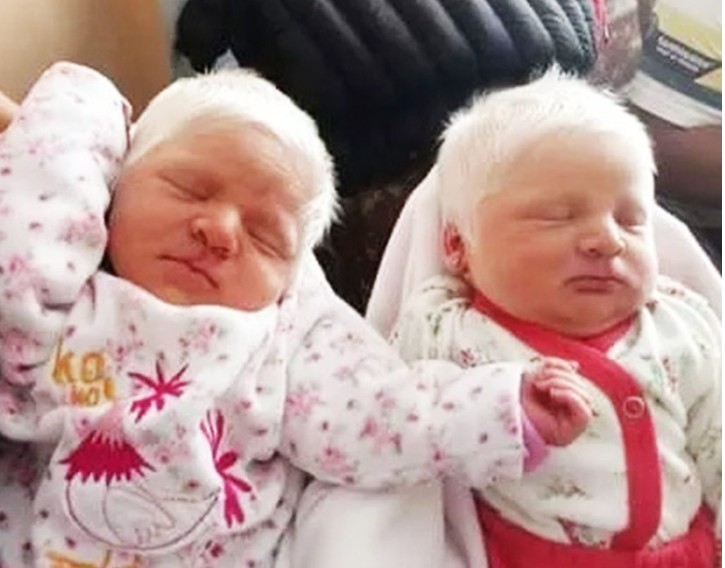 The First Ever Albino Twins Born In Argentina Will Leave You In Awe