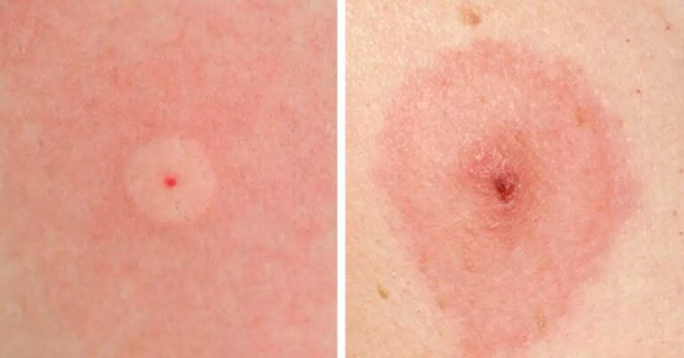 How To Identify 10 Of The Most Common Bug Bites