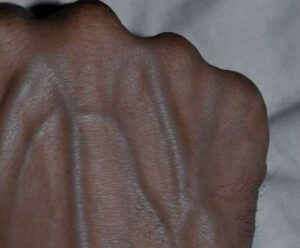 Visible Veins Explained: Normal Causes, Health Risks, and When to Worry