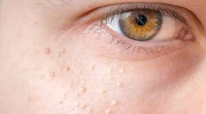 Experts issue serious warning to people with series of white spots on their body and private parts