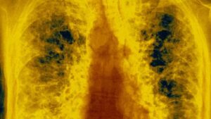 Why popcorn lung is increasingly affecting young adults as urgent warning issued