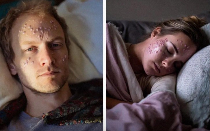 My Husband Caught Chickenpox ‘On a Work Trip’ – My Stepsister’s Spots Exposed the Truth