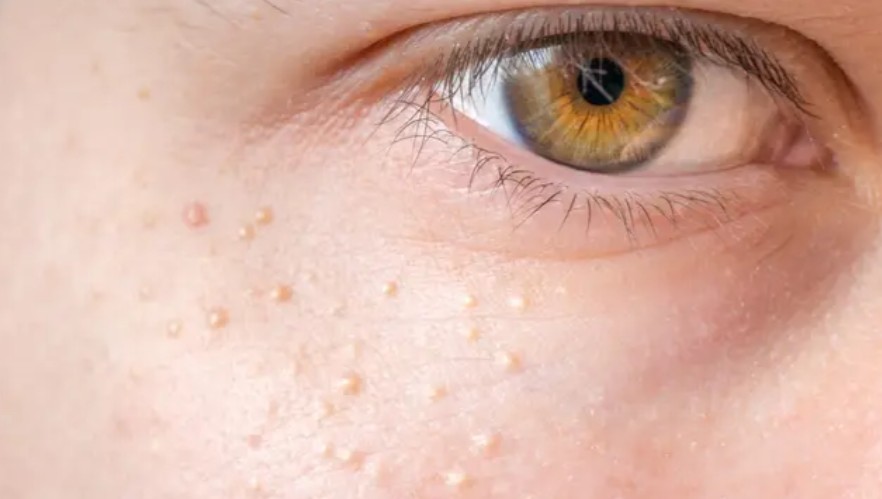 Doctor explains how to get rid of small white spots that appear all over your body