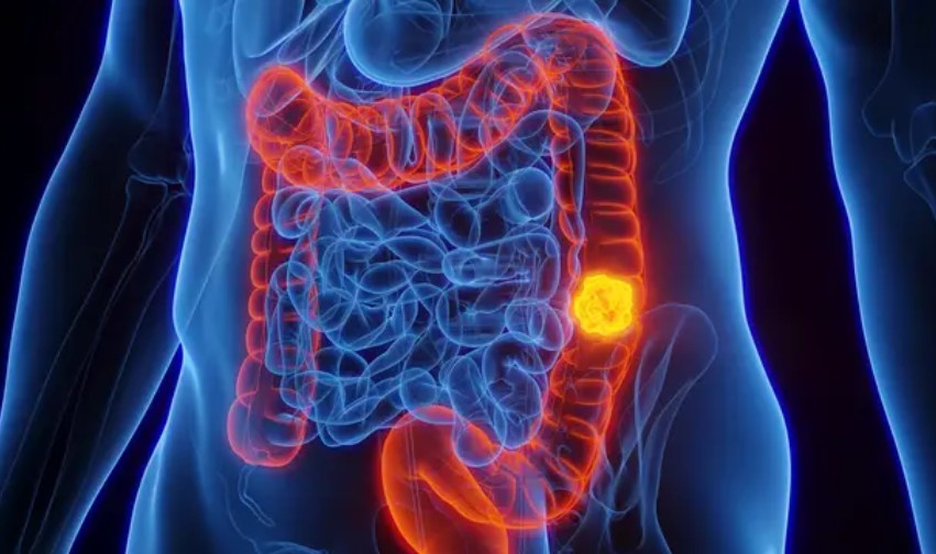 Woman with stage four colon cancer reveals five symptoms she initially dismissed