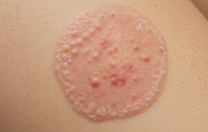 Ringworm 101: Causes, Symptoms, and Simple Remedies You Can Try at Home