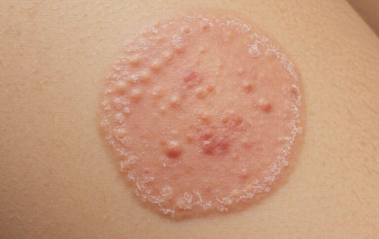 Ringworm 101: Causes, Symptoms, and Simple Remedies You Can Try at Home