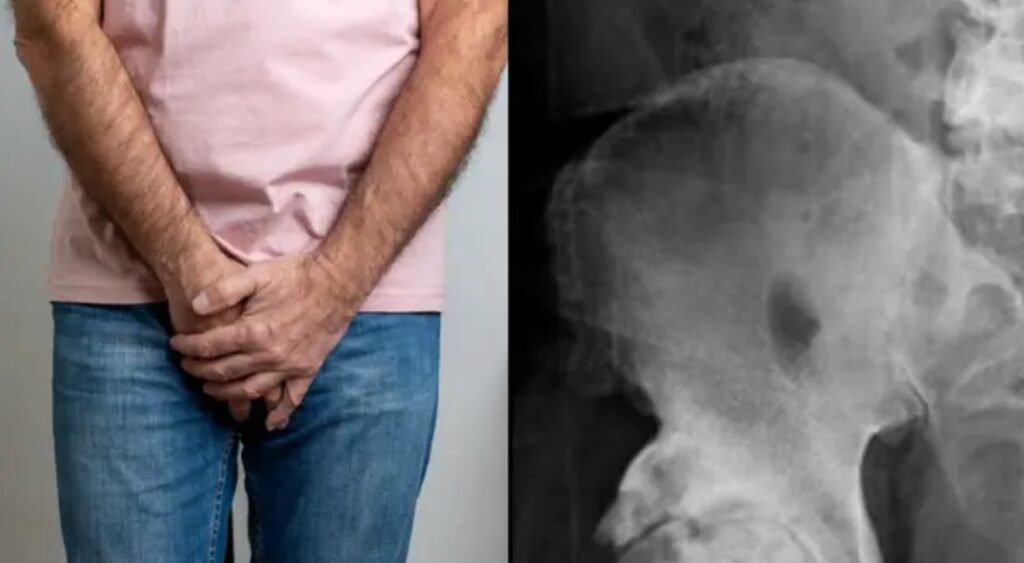 Man goes to doctors for hip X-ray and finds out his penis is turning into bone