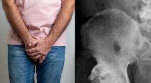 Man goes to doctors for hip X-ray and finds out his penis is turning into bone
