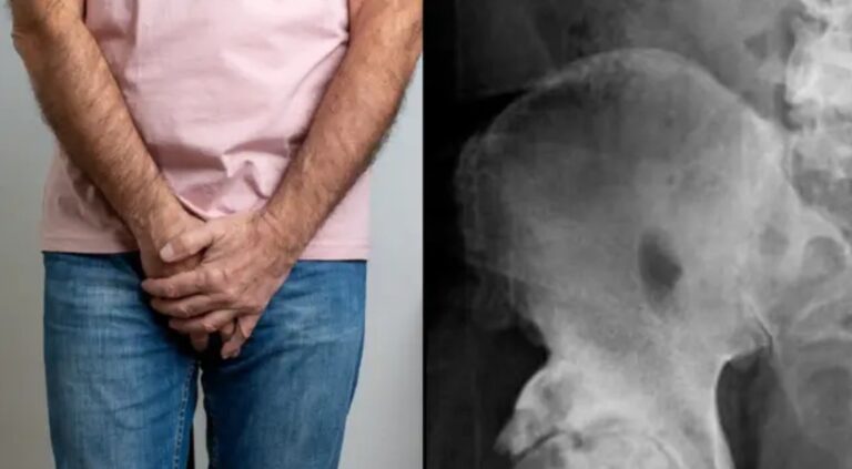 Man goes to doctors for hip X-ray and finds out his penis is turning into bone