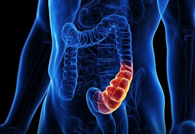 This one food is found in 80% of colon cancer patients’ diets according to oncologist