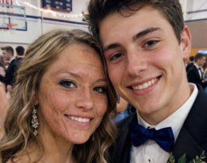A Boy Asked Me to Dance at Prom Because No One Else Would Due to My Scars – The Next Day, His Parents and Officers Showed up at My Door