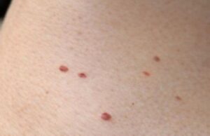 Red Dots on Your Skin: Causes and What They Could Mean…